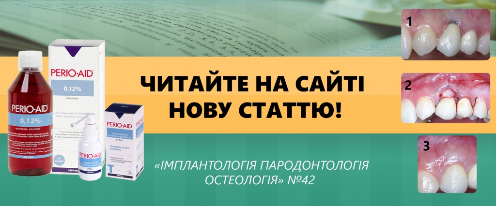 Нова стаття! "Мукогінгівальна хірургія після імплантації: коригування наслідків періімплантитів"