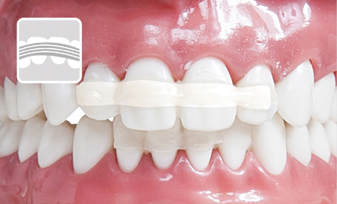 U.P. FIBER SPLINT, стрічка для шинування 3 мм*20 см, 2 шт.
