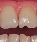 Клінічний випадок із використанням гібридного композиту з ультрадрібними частками наповнювача Essentia.