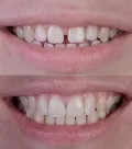 Клінічний випадок естетичного відновлення твердих тканин зуба вінірами
