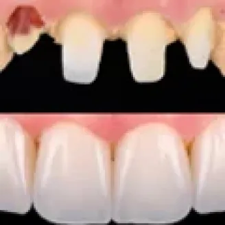 Клінічний випадок від техніка-демонстратора GC Ukraine Павла Мілованова