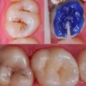 Клінічний випадок з EQUIA Forte