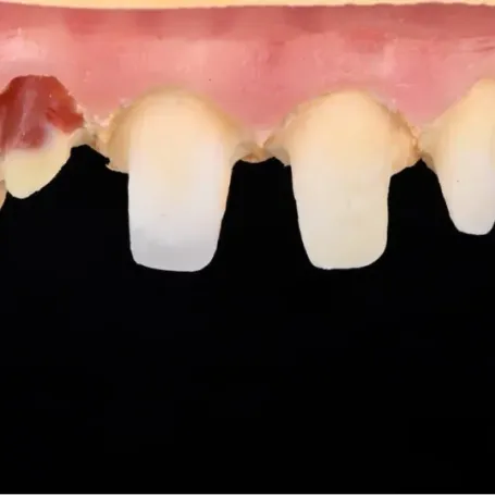 Клінічний випадок від техніка-демонстратора GC Ukraine Павла Мілованова