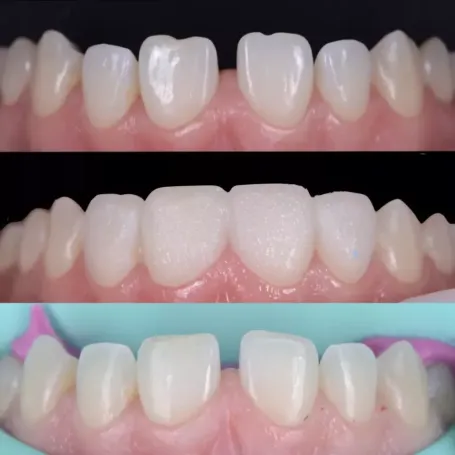 Клінічний випадок естетичного відновлення твердих тканин зуба вінірами