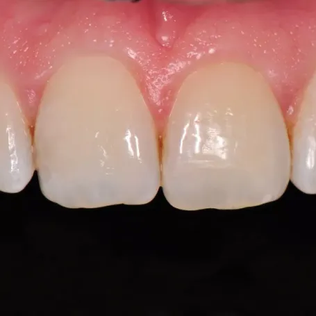 Клінічний випадок із використанням гібридного композиту з ультрадрібними частками наповнювача Essentia.
