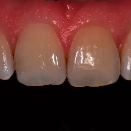 Клінічний випадок із використанням гібридного композиту з ультрадрібними частками наповнювача Essentia.
