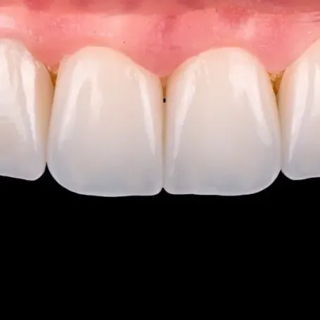 Клінічний випадок від техніка-демонстратора GC Ukraine Павла Мілованова