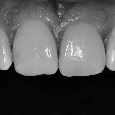 Клінічний випадок із використанням гібридного композиту з ультрадрібними частками наповнювача Essentia.