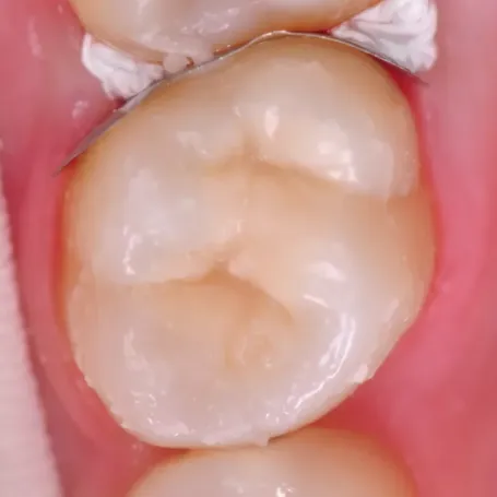 Клінічний випадок з EQUIA Forte