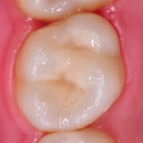 Клінічний випадок з EQUIA Forte