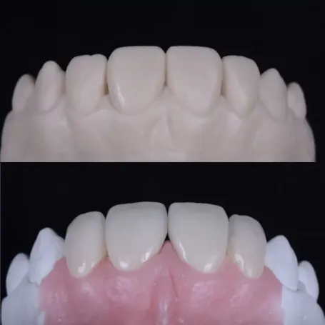 Клінічний випадок естетичного відновлення твердих тканин зуба вінірами