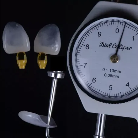 Клінічний випадок естетичного відновлення твердих тканин зуба вінірами