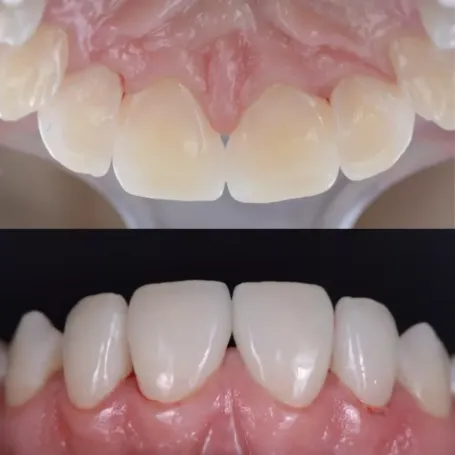 Клінічний випадок естетичного відновлення твердих тканин зуба вінірами