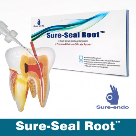 SURE-SEAL ROOT – матеріал для складних клінічних випадків обтурації кореневих каналів